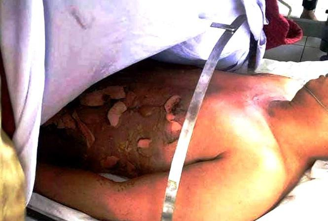 Cháy nửa người vì đổ xăng lẻ ở ven đường