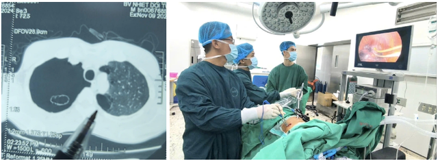 Một bệnh nhân bị thủng phổi do hút thuốc liên tục - Ảnh 1.