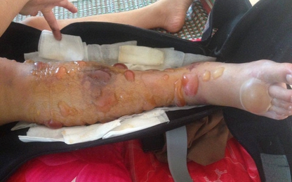 Cô gái phải cưa chân vì bệnh viện tắc trách