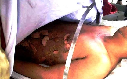 Cháy nửa người vì đổ xăng lẻ ở ven đường