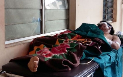 Đắk Lắk: Nam thanh niên cháy mặt, nát tay khi làm lẩu nhậu